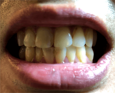使用前の歯