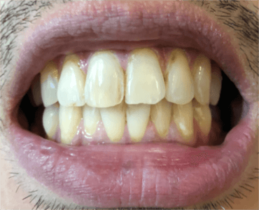 20日後の歯